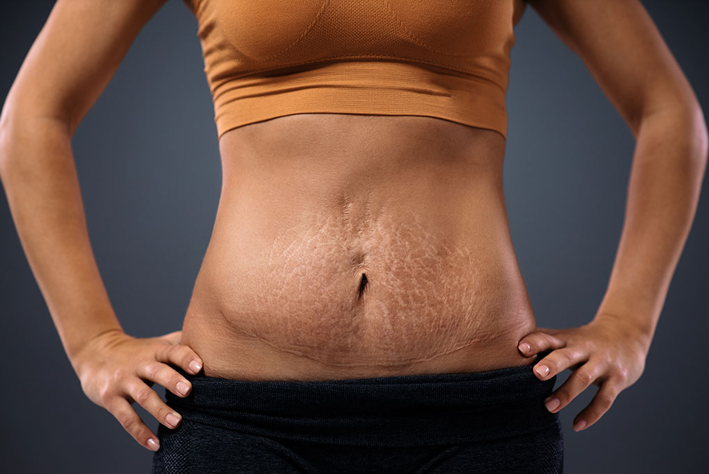 Gordura embaixo da cicatriz de cesárea: tem como tratar? - Dra
